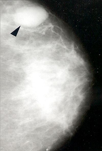 2013年实践技能医师医学影像学:乳腺纤维腺瘤
