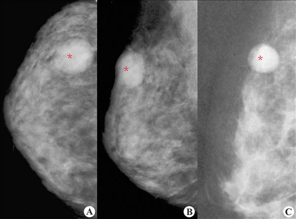 【x线钼靶摄影图片】:; 乳腺纤维腺瘤2-x线钼靶摄影病例影像诊断