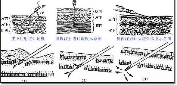 2014年护士资格证基础护理:各种注射法分论