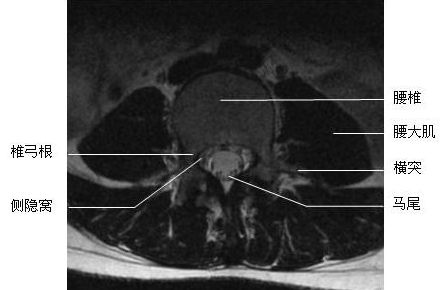 2014年实践技能医师医学影像学:腰段横断面-mri图