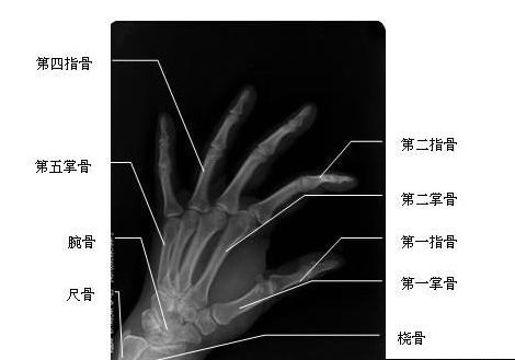 2014年实践技能医师医学影像学:手斜位-x线